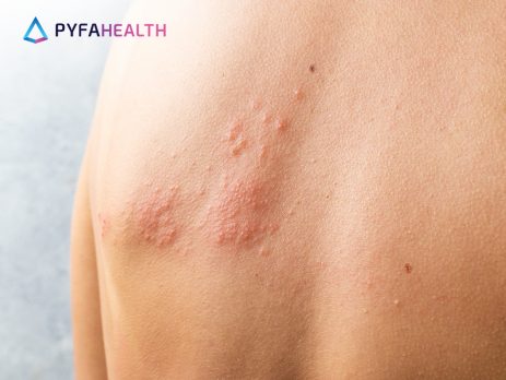 Gejala Herpes, Faktor Risiko, dan Penanganan