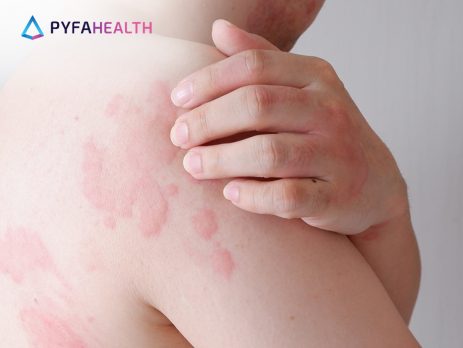 cara menghilangkan biduran dengan cepat