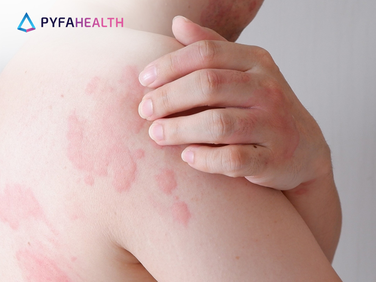 cara menghilangkan biduran dengan cepat