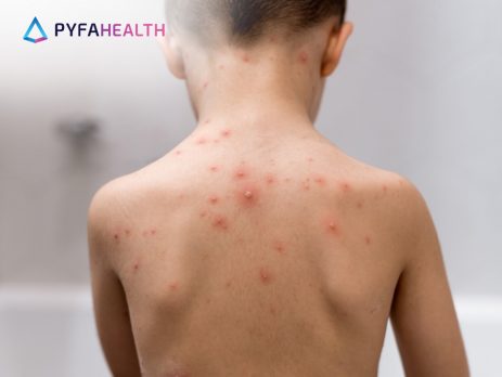Varisela adalah penyakit menular yang lebih dikenal dengan sebutan cacar air. Ketahui penyebab, gejala, dan cara meredakan gatal akibat varisela!