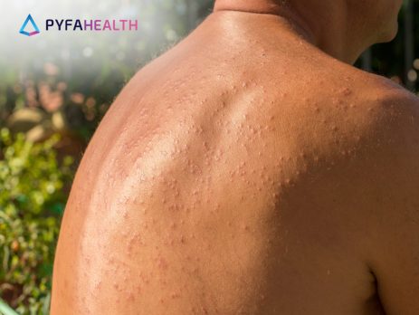 alergi panas matahari