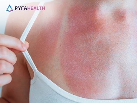 cara mengatasi kulit terbakar matahari