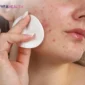 Skincare untuk Kulit Berminyak